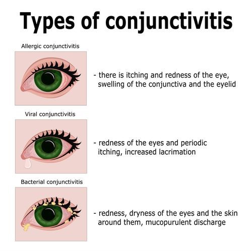 eye flu types