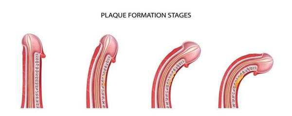 peyronies disease